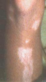 Description: Description: Description: Knee and shin, pink spots, 7-23-96.